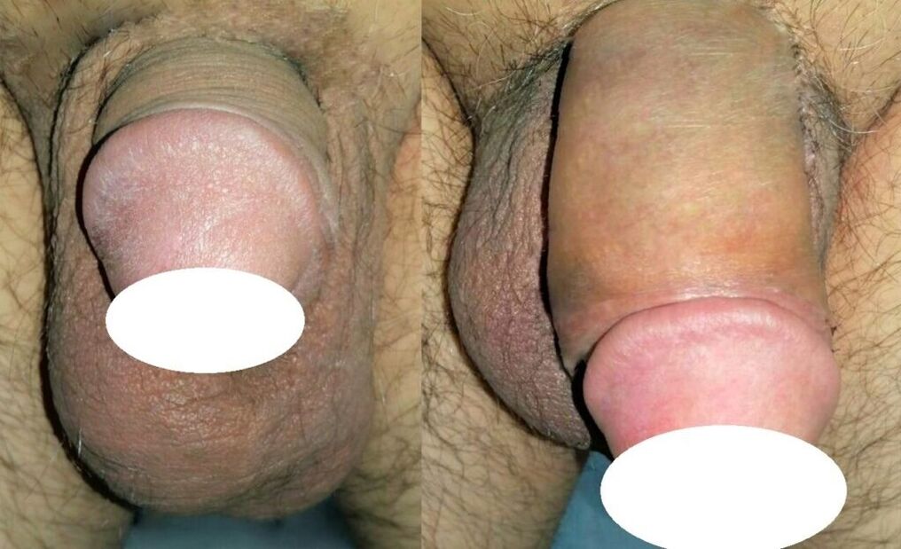 Fotos vor und nach der Penisvergrößerung